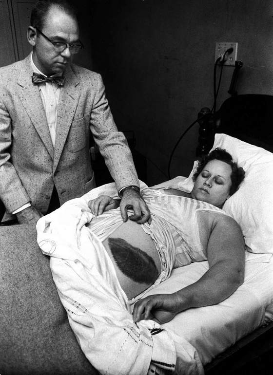 Муді Джейкобс показує гігантський синець на боці та стегні своєї пацієнтки Енн Ходжес у 1954 році після того, як у неї влучив метеорит